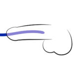 Silikone Dilator Sæt med 3 stk